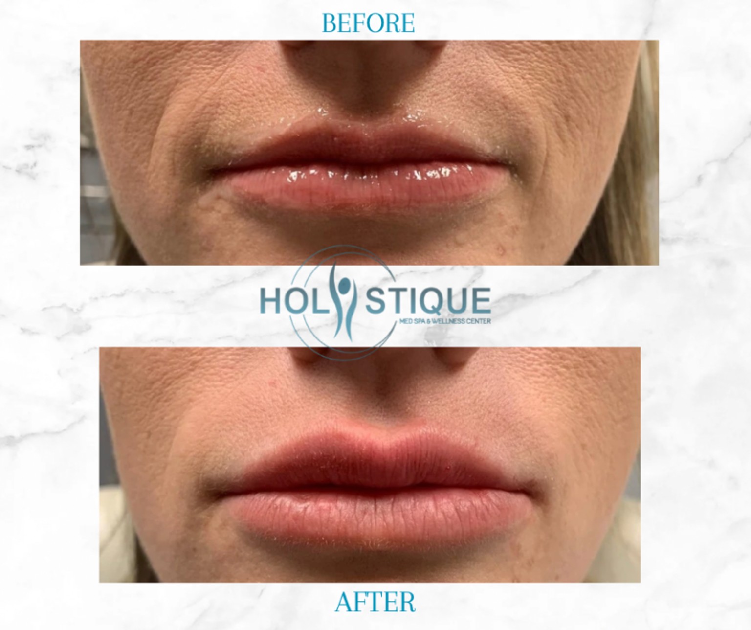 Lip filler before-and-after result at Holistique Med Spa in Gainesville, Georgia