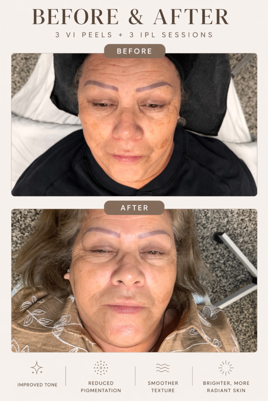 Before-and-after result after three VI Peels and three IPL sessions at Holistique Med Spa