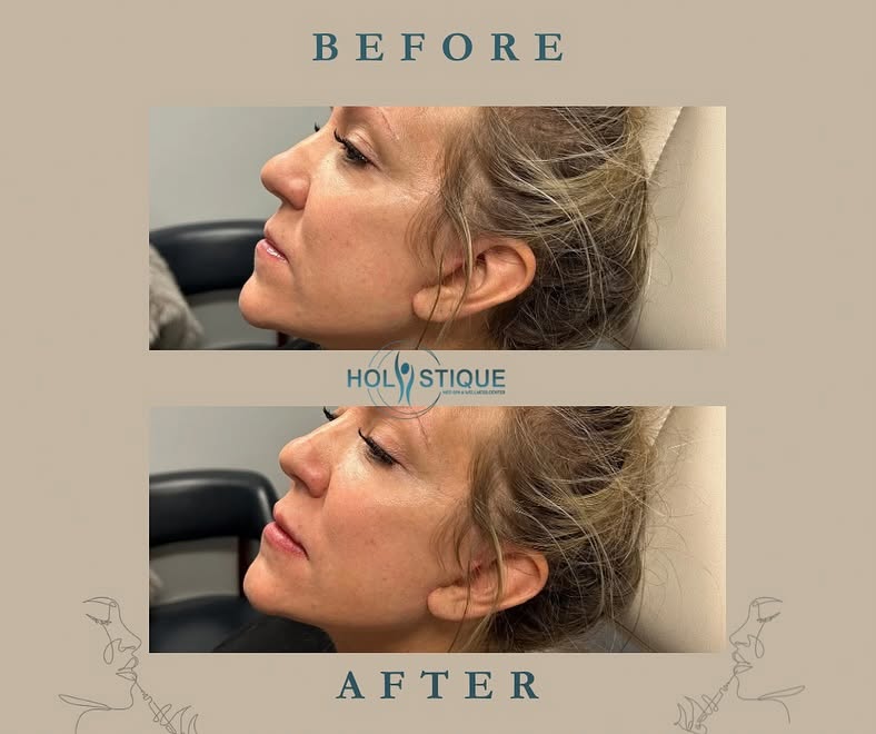 Lip filler before-and-after result at Holistique Med Spa in Gainesville, Georgia — image 1