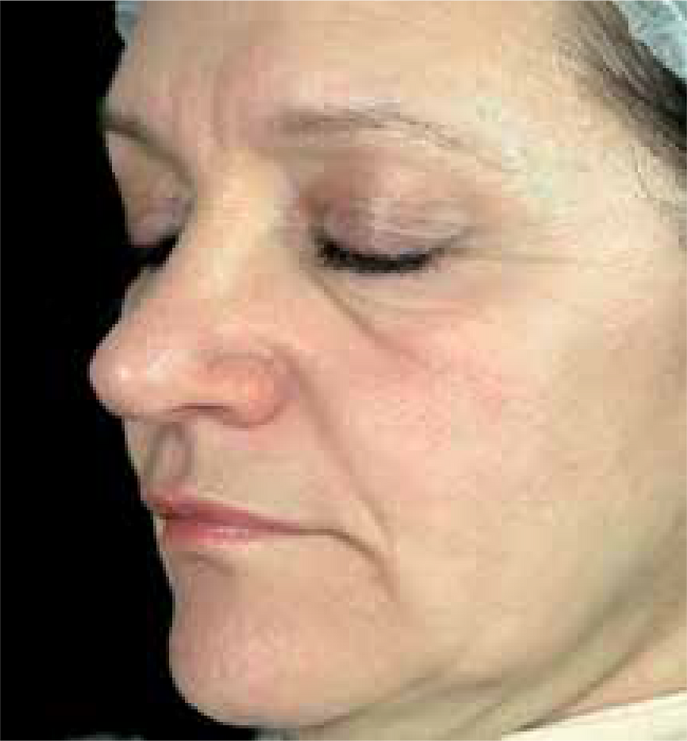 Before Jalupro skin biorevitalization treatment; individual results vary