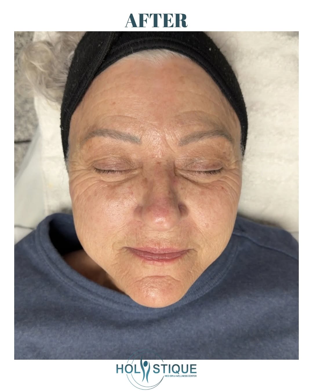 Before-and-after result after three Lumecca IPL treatments at Holistique Med Spa — image 2