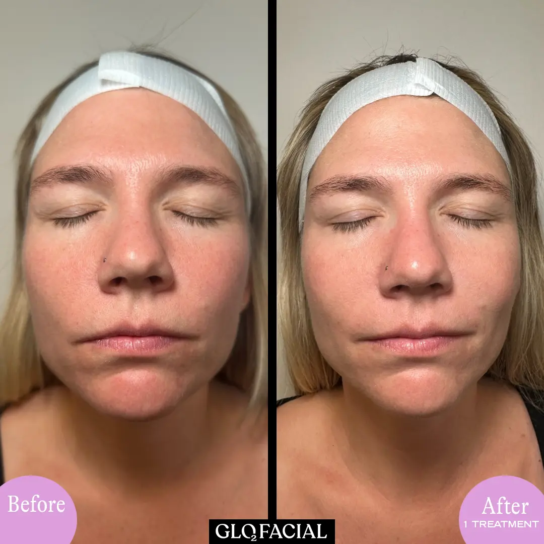 Glo2Facial Firm with RF Pro before and after